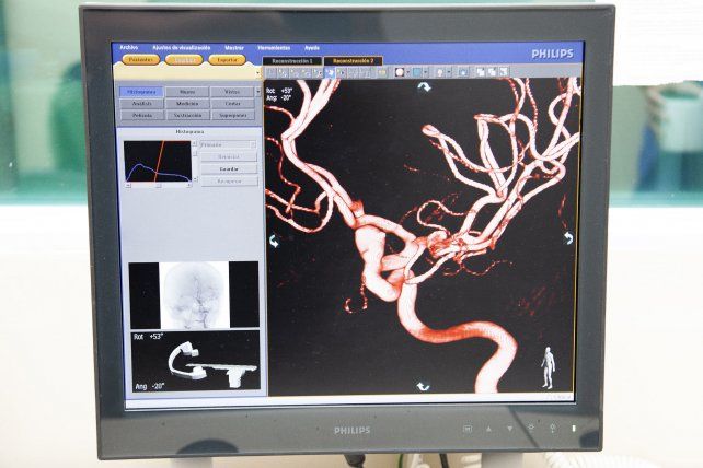 Porque se da un aneurisma cerebral
