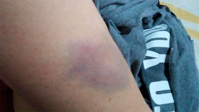 Mujer mostró las marcas de los golpes de su expareja: