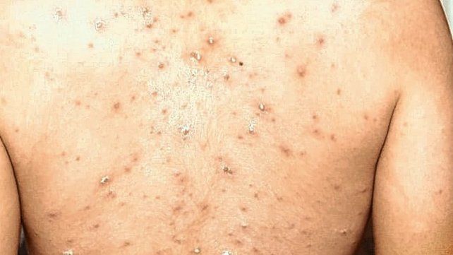 El Ministerio de Salud reportó un caso con "síntomas compatibles con viruela símica".