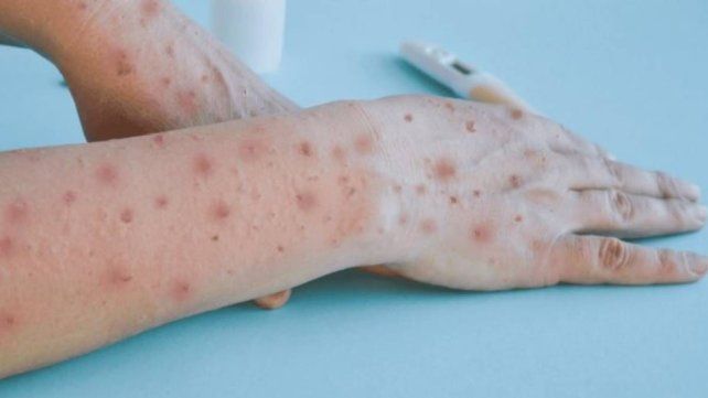 La viruela símica fue declarada emergencia de salud pública de importancia internacional por parte de la Organización Mundial de la Salud La viruela símica fue declarada emergencia de salud pública de importancia internacional por parte de la Organización Mundial de la Salud