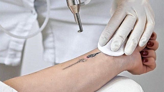 Borrar un tatuaje hoy es posible