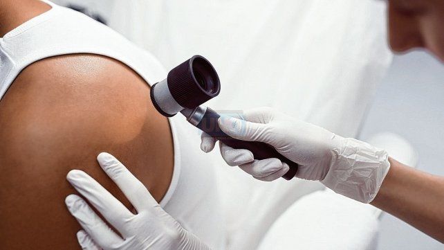 Con una lupa. Dermatoscópica los dermatólogos observan las características con más detalle de las lesiones que son pigmentadas.