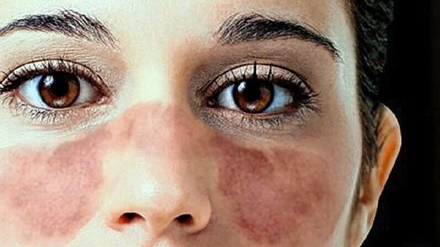 El lupus eritematoso sistémico es una enfermedad crónica autoinmune El lupus eritematoso sistémico es una enfermedad crónica autoinmune