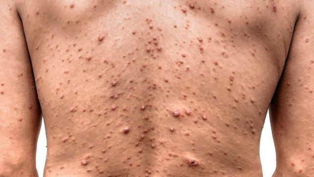 La varicela es una enfermedad benigna, pero muy molesta La varicela es una enfermedad benigna, pero muy molesta