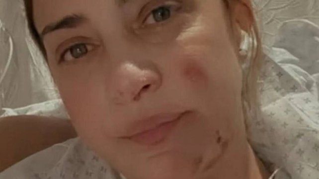 María Julia Oliván mostró las heridas que sufrió por un accidente doméstico María Julia Oliván mostró las heridas que sufrió por un accidente doméstico
