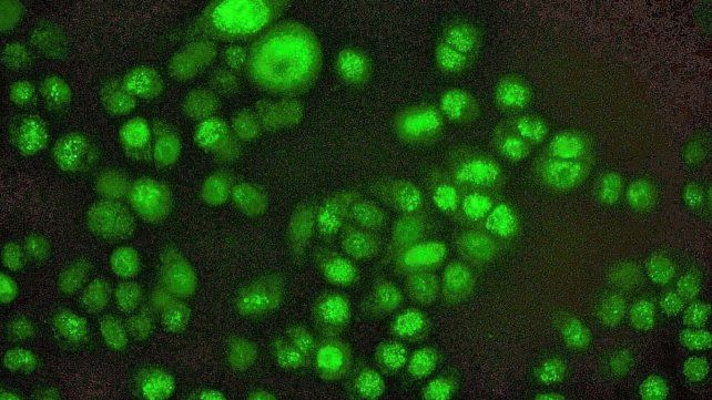 Células. De cáncer de mama triple negativo expresando la proteína Foxp3 después del tratamiento con quimioterapia. Células. De cáncer de mama triple negativo expresando la proteína Foxp3 después del tratamiento con quimioterapia.