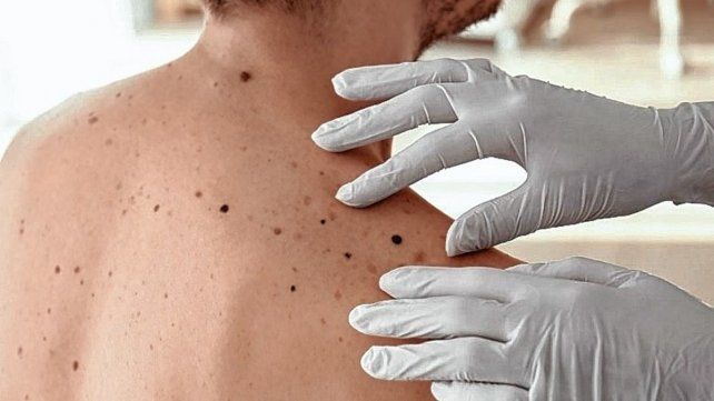 Los controles son claves para detectar a tiempo el cáncer de piel Los controles son claves para detectar a tiempo el cáncer de piel