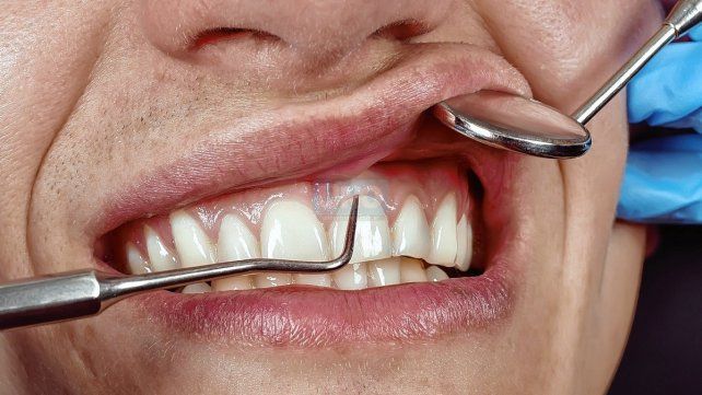 Estadísticas. El cáncer bucal representa alrededor del 4% de todos los cánceres, es decir que de cien personas con cáncer, cuatro lo tendrán ubicado en el área de la boca.