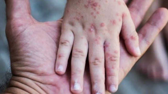 El Gobierno nacional quiere evitar la propagación de la enfermedad. El Gobierno nacional quiere evitar la propagación de la enfermedad.