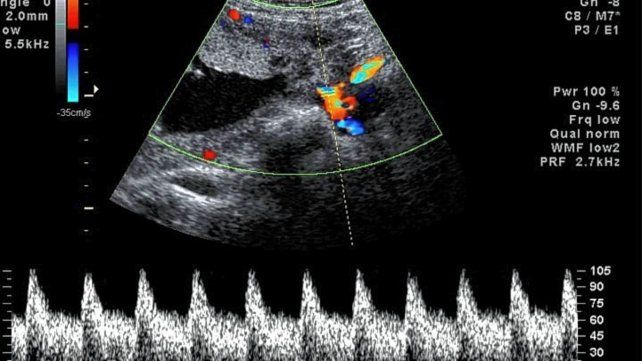 El control. Durante el embarazo es importantísimo, ya que las cardiopatías se desarrollan y se pueden detectar a partir de la 8ª semana del embarazo.