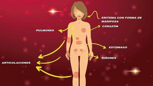 El lupus puede afectar diferentes sistemas u órganos y generar daños irreversibles El lupus puede afectar diferentes sistemas u órganos y generar daños irreversibles