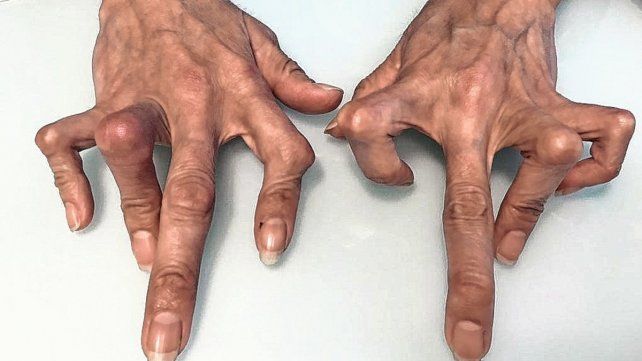 Las enfermedades reumáticas pueden generar dolor y deformaciones que afectan la autonomía.