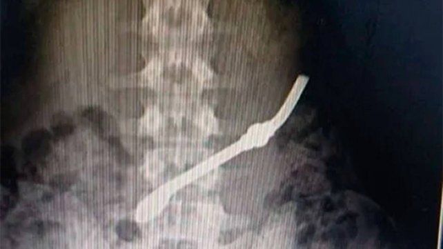 Un interno de la cárcel de Gualeguay se tragó una bombilla en señal de protesta Un interno de la cárcel de Gualeguay se tragó una bombilla en señal de protesta