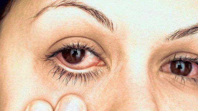 El formol, que se utiliza en ciertos modos de alisado, puede irritar la vista, las mucosas y la piel El formol, que se utiliza en ciertos modos de alisado, puede irritar la vista, las mucosas y la piel